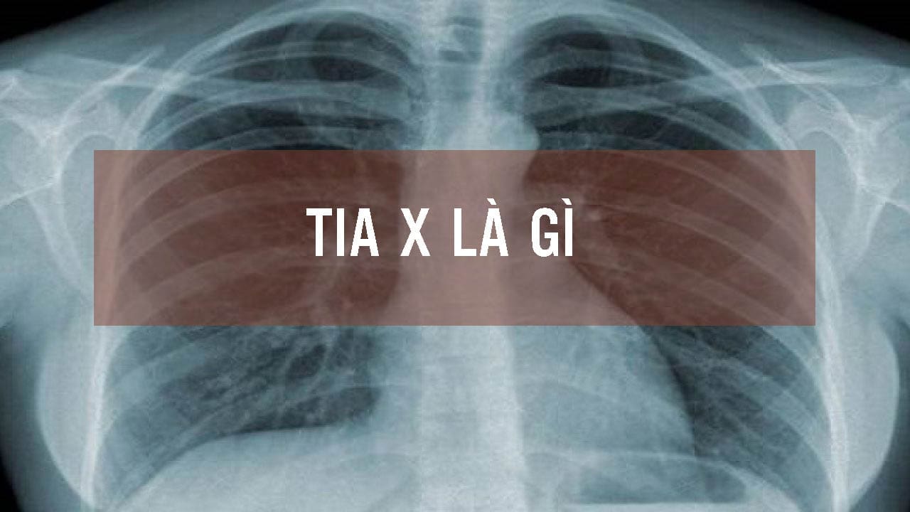 Tia X là gì? TIA_X_LÀ_GÌ